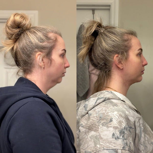 Meghann’s Lower Facelift + Chin Implant Story